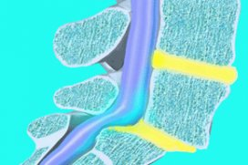 Смещение позвонков поясничного отдела позвоночника