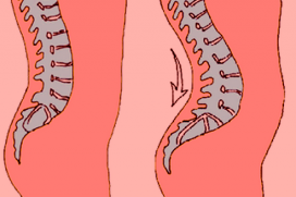 Лордоз поясничного отдела