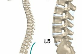 Кифоз поясничного отдела позвоночника